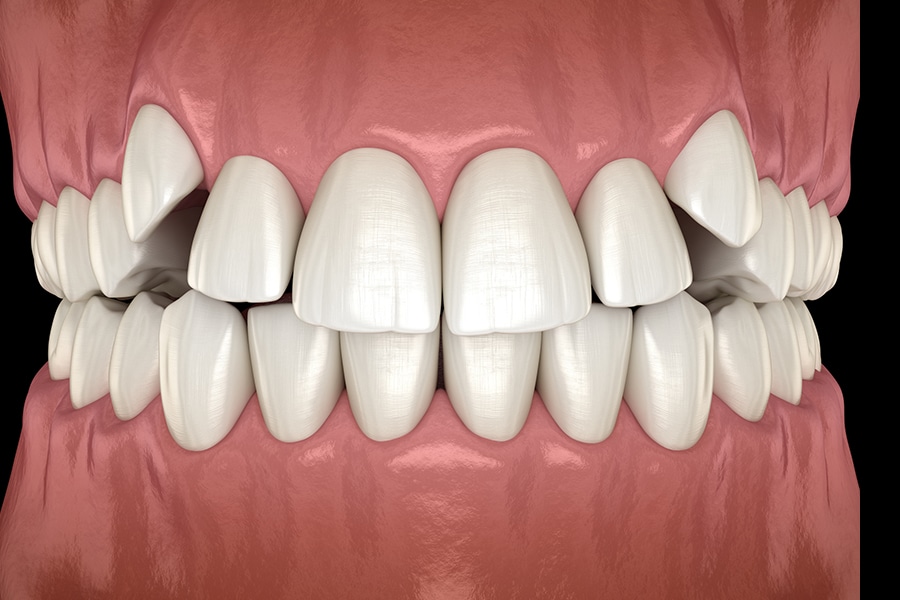 Crowded Teeth Example
