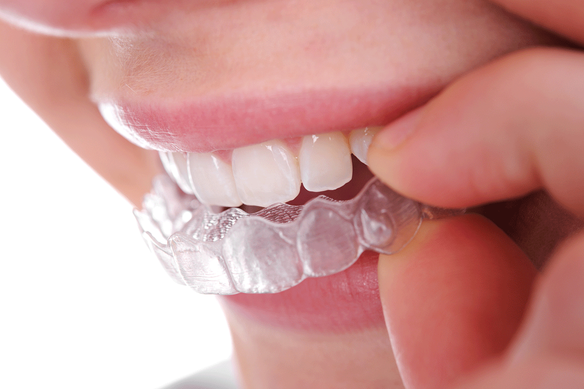 How Long Do You Have To Wear Invisalign? Quincy Family Orthodontics