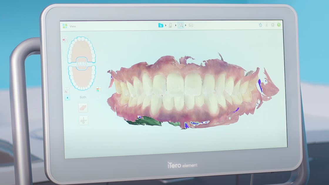 digital intraoral scanner